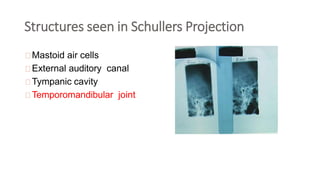 Structures seen in Schullers Projection
Mastoid air cells
External auditory canal
Tympanic cavity
Temporomandibular joint
 