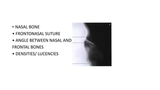 • NASAL BONE
• FRONTONASAL SUTURE
• ANGLE BETWEEN NASAL AND
FRONTAL BONES
• DENSITIES/ LUCENCIES
 