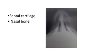 •Septal cartilage
• Nasal bone
 