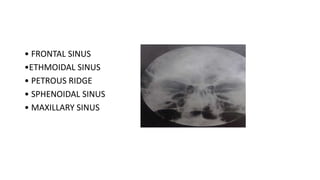 • FRONTAL SINUS
•ETHMOIDAL SINUS
• PETROUS RIDGE
• SPHENOIDAL SINUS
• MAXILLARY SINUS
 