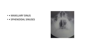 • • MAXILLARY SINUS
• • SPHENOIDAL SINUSES
 