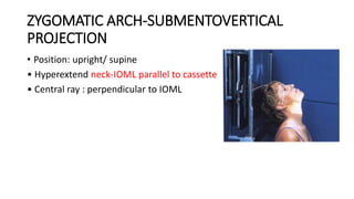 ZYGOMATIC ARCH-SUBMENTOVERTICAL
PROJECTION
• Position: upright/ supine
• Hyperextend neck-IOML parallel to cassette
• Central ray : perpendicular to IOML
 