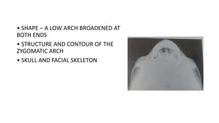 • SHAPE – A LOW ARCH BROADENED AT
BOTH ENDS
• STRUCTURE AND CONTOUR OF THE
ZYGOMATIC ARCH
• SKULL AND FACIAL SKELETON
 