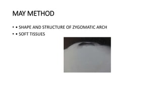 MAY METHOD
• • SHAPE AND STRUCTURE OF ZYGOMATIC ARCH
• • SOFT TISSUES
 