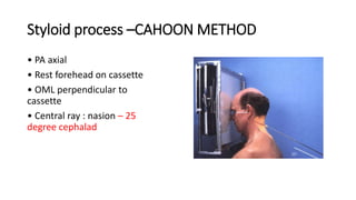 Styloid process –CAHOON METHOD
• PA axial
• Rest forehead on cassette
• OML perpendicular to
cassette
• Central ray : nasion – 25
degree cephalad
 
