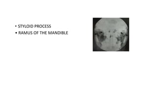• STYLOID PROCESS
• RAMUS OF THE MANDIBLE
 