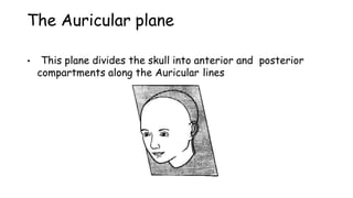 The Auricular plane
• This plane divides the skull into anterior and posterior
compartments along the Auricular lines
 