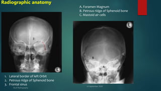 Petrous Ridge Positioning Chart Skull radiography by sandesh Magar | PPTX