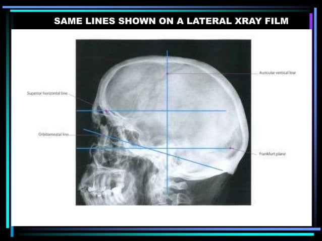 Skull radiography | PPTX | Death, Injury, or Military Conflict ...