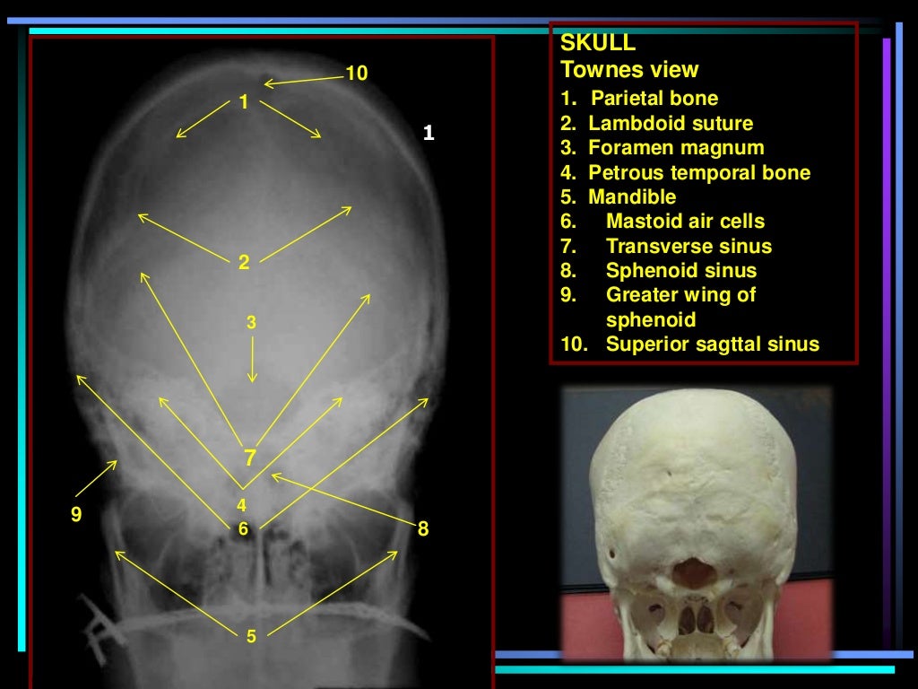 Skull radiography