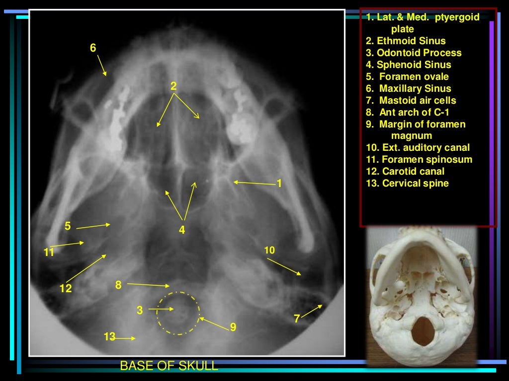 Skull radiography