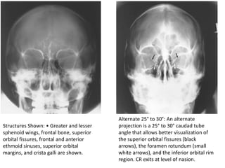 Alternate 25° to 30°: An alternate
projection is a 25° to 30° caudad tube
angle that allows better visualization of
the superior orbital fissures (black
arrows), the foramen rotundum (small
white arrows), and the inferior orbital rim
region. CR exits at level of nasion.
Structures Shown: • Greater and lesser
sphenoid wings, frontal bone, superior
orbital fissures, frontal and anterior
ethmoid sinuses, superior orbital
margins, and crista galli are shown.
 