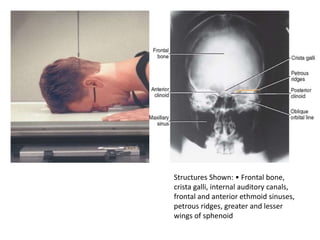 Structures Shown: • Frontal bone,
crista galli, internal auditory canals,
frontal and anterior ethmoid sinuses,
petrous ridges, greater and lesser
wings of sphenoid
 