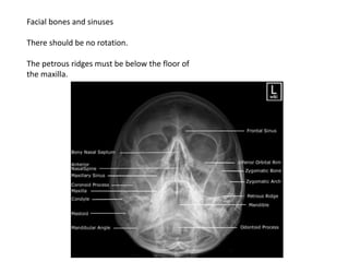 Facial bones and sinuses
There should be no rotation.
The petrous ridges must be below the floor of
the maxilla.
 