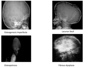 Osteogenesis Imperfecta Lacunar Skull
Osteopetrosis Fibrous dysplasia
 
