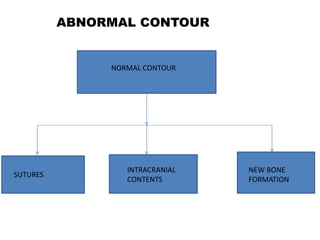 ABNORMAL CONTOUR
NORMAL CONTOUR
SUTURES
INTRACRANIAL
CONTENTS
NEW BONE
FORMATION
 