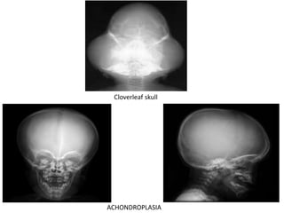Cloverleaf skull
ACHONDROPLASIA
 
