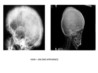 HAIR – ON END APPEARNCE
 