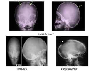 Paritel Foramina
DERMOID ENCEPHALOCELE
 