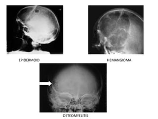 EPIDERMOID HEMANGIOMA
OSTEOMYELITIS
 
