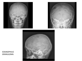 EOSINOPHILIC
GRANULOMA
 