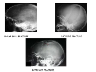 LINEAR SKULL FRACTURE GROWING FRACTURE
DEPRESSED FRACTURE
 