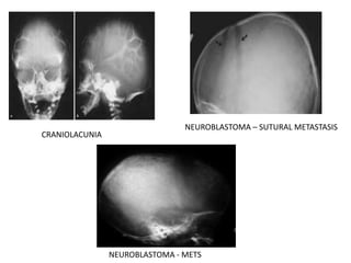 CRANIOLACUNIA
NEUROBLASTOMA – SUTURAL METASTASIS
NEUROBLASTOMA - METS
 