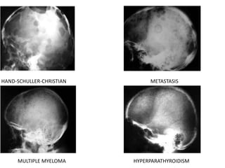 HAND-SCHULLER-CHRISTIAN METASTASIS
MULTIPLE MYELOMA HYPERPARATHYROIDISM
 