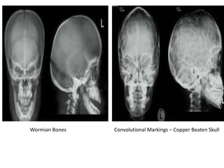 Wormian Bones Convolutional Markings – Copper Beaten Skull
 
