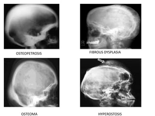 OSTEOPETROSIS FIBROUS DYSPLASIA
OSTEOMA HYPEROSTOSIS
 