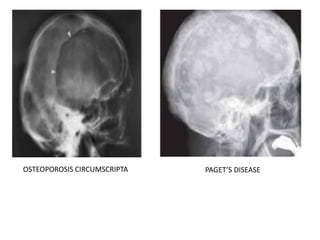 OSTEOPOROSIS CIRCUMSCRIPTA PAGET’S DISEASE
 