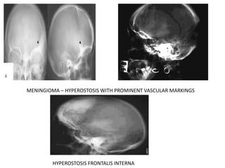 MENINGIOMA – HYPEROSTOSIS WITH PROMINENT VASCULAR MARKINGS
HYPEROSTOSIS FRONTALIS INTERNA
 
