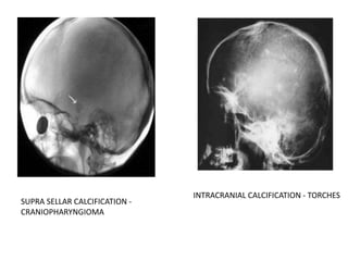 SUPRA SELLAR CALCIFICATION -
CRANIOPHARYNGIOMA
INTRACRANIAL CALCIFICATION - TORCHES
 
