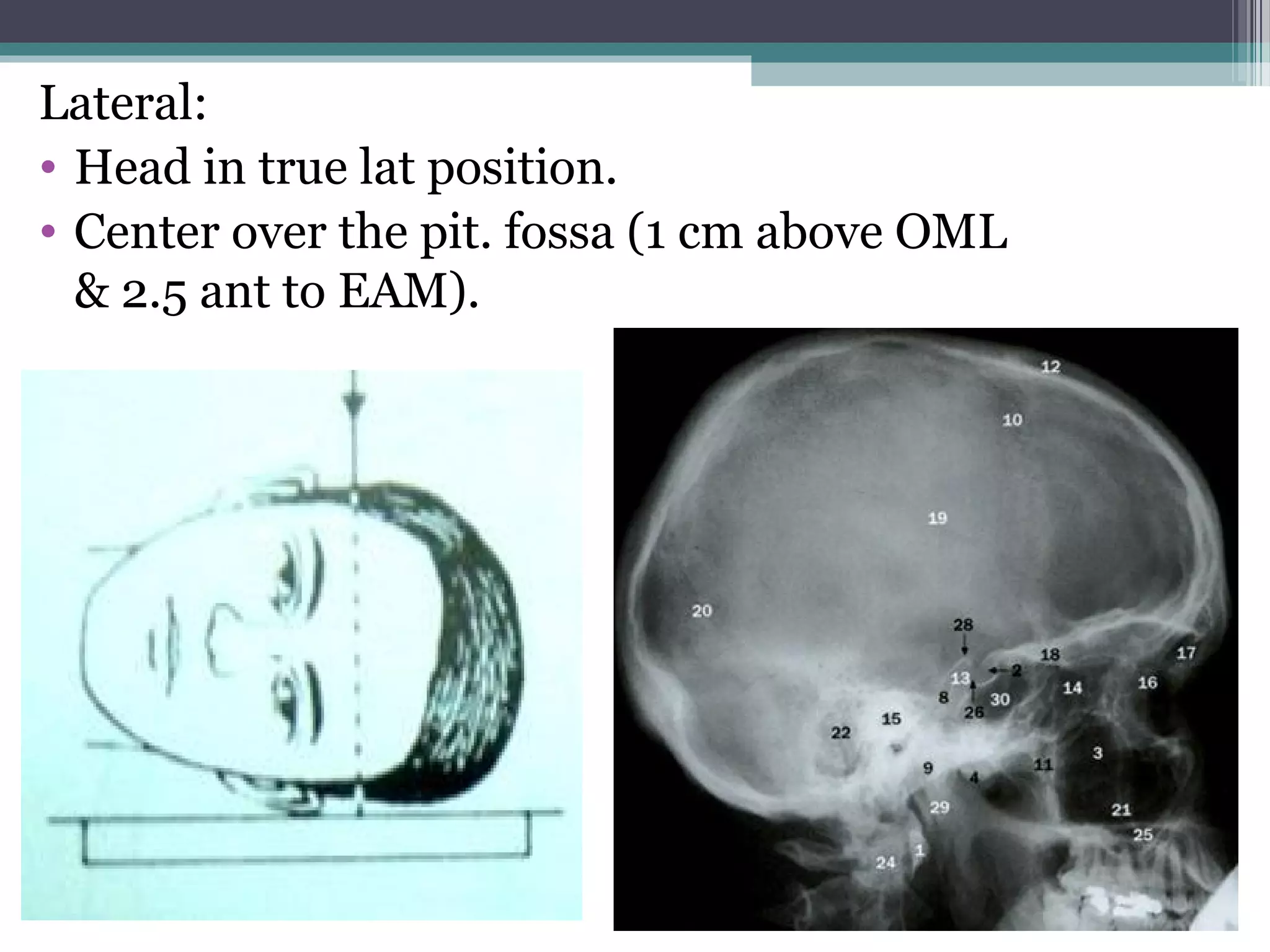 Lateral:
• Head in true lat position.
• Center over the pit. fossa (1 cm above OML
& 2.5 ant to EAM).
 