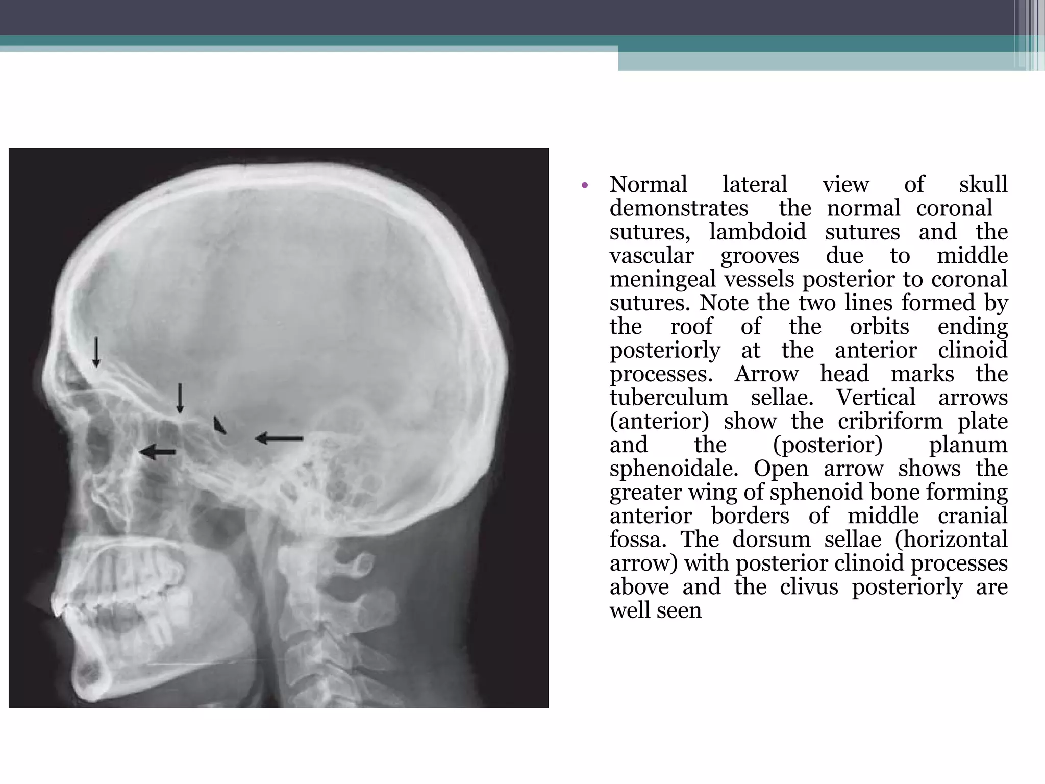 • Normal lateral view of skull
demonstrates the normal coronal
sutures, lambdoid sutures and the
vascular grooves due to middle
meningeal vessels posterior to coronal
sutures. Note the two lines formed by
the roof of the orbits ending
posteriorly at the anterior clinoid
processes. Arrow head marks the
tuberculum sellae. Vertical arrows
(anterior) show the cribriform plate
and the (posterior) planum
sphenoidale. Open arrow shows the
greater wing of sphenoid bone forming
anterior borders of middle cranial
fossa. The dorsum sellae (horizontal
arrow) with posterior clinoid processes
above and the clivus posteriorly are
well seen
 