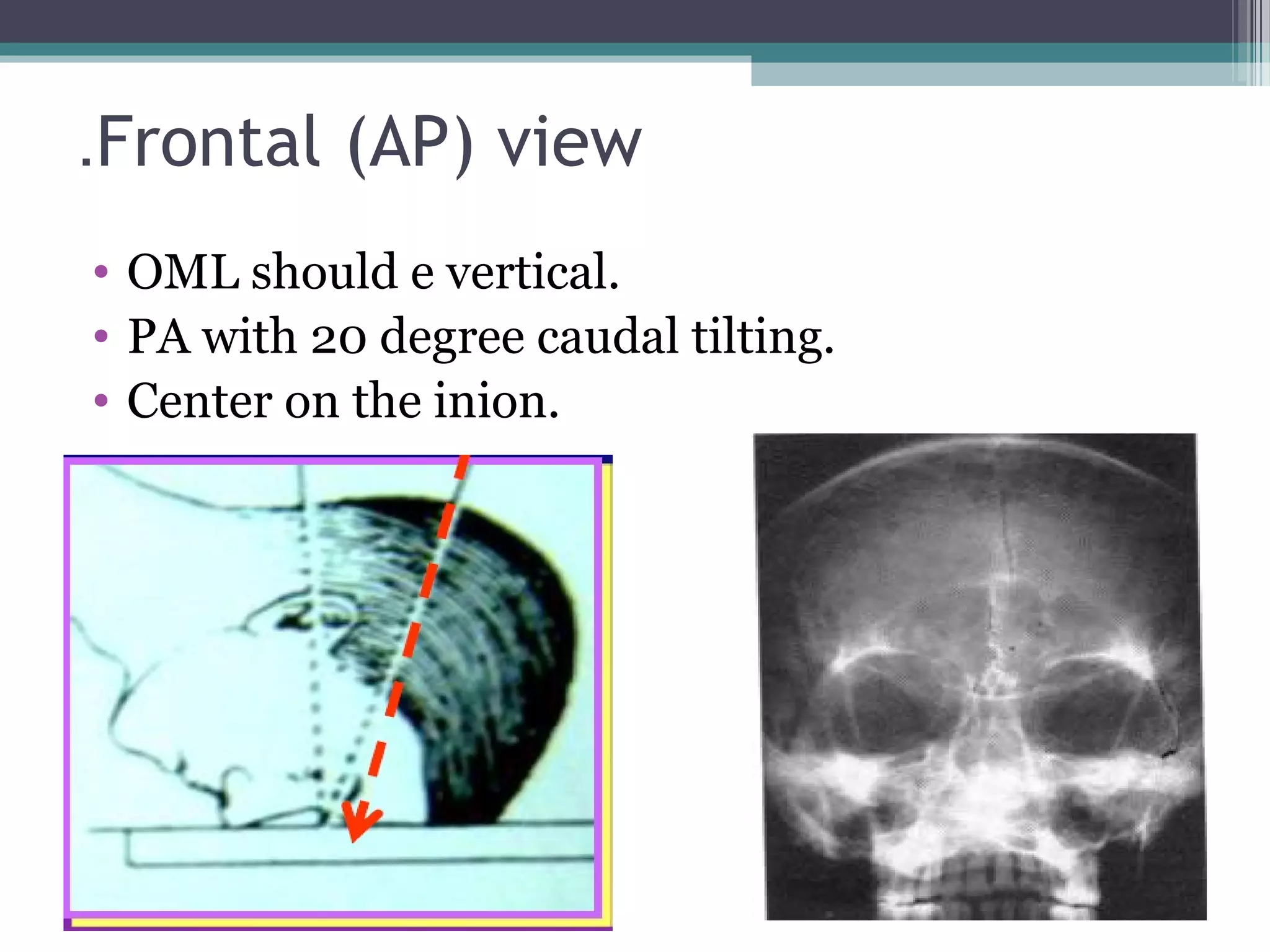 Frontal (AP) view.
• OML should e vertical.
• PA with 20 degree caudal tilting.
• Center on the inion.
 