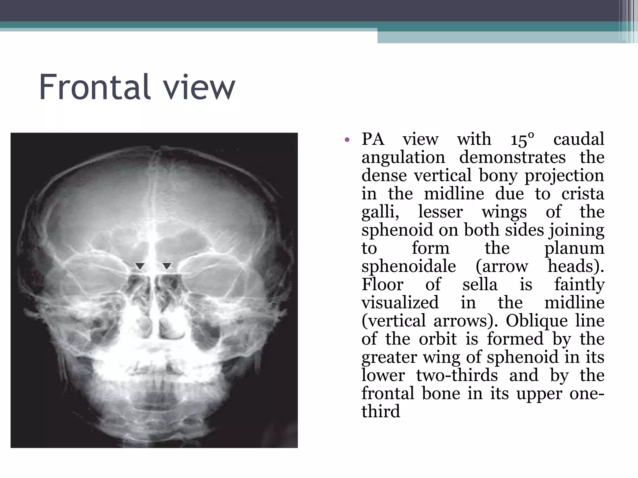Frontal view
• PA view with 15° caudal
angulation demonstrates the
dense vertical bony projection
in the midline due to crista
galli, lesser wings of the
sphenoid on both sides joining
to form the planum
sphenoidale (arrow heads).
Floor of sella is faintly
visualized in the midline
(vertical arrows). Oblique line
of the orbit is formed by the
greater wing of sphenoid in its
lower two-thirds and by the
frontal bone in its upper one-
third
 