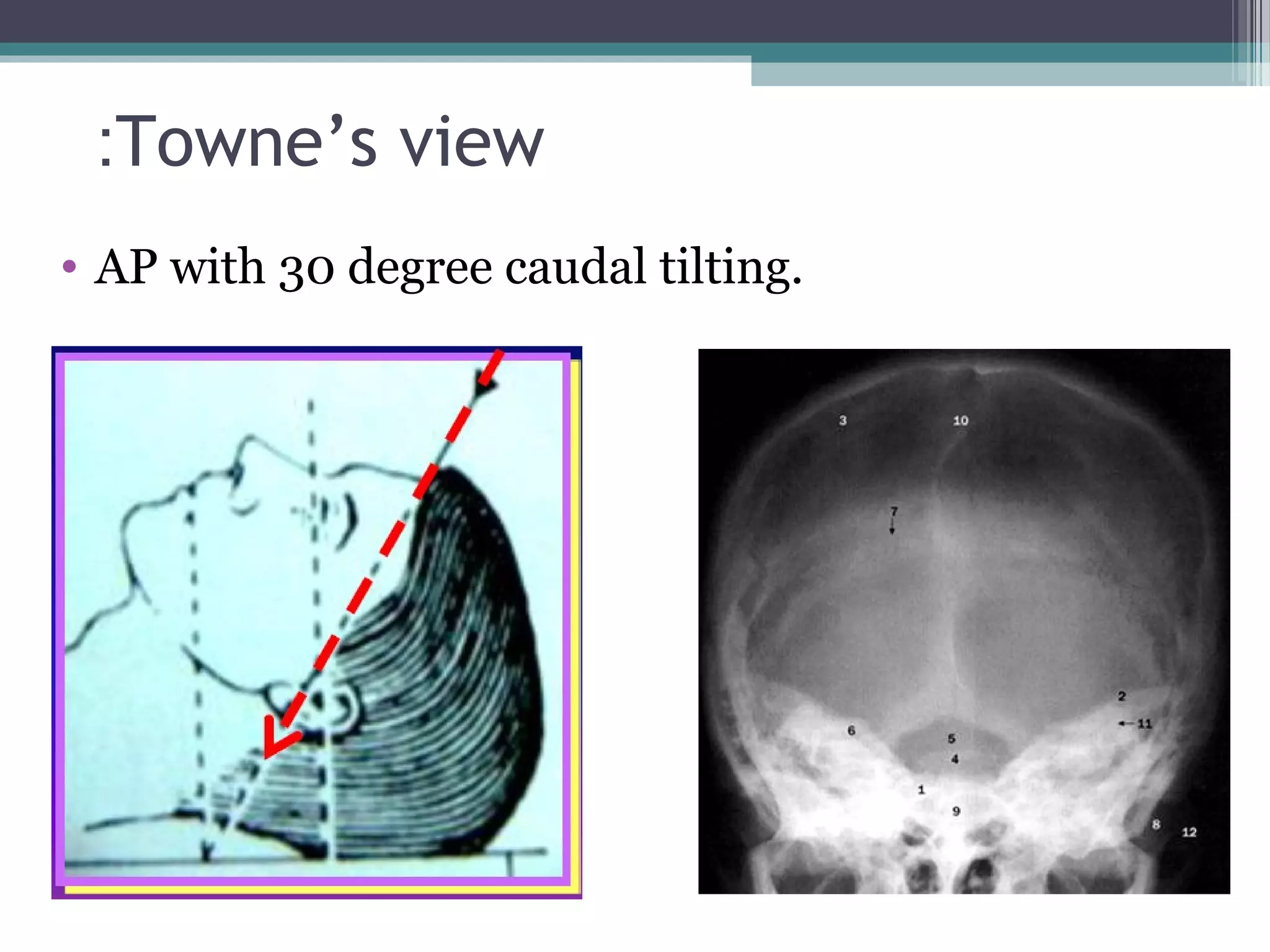Towne’s view:
• AP with 30 degree caudal tilting.
 