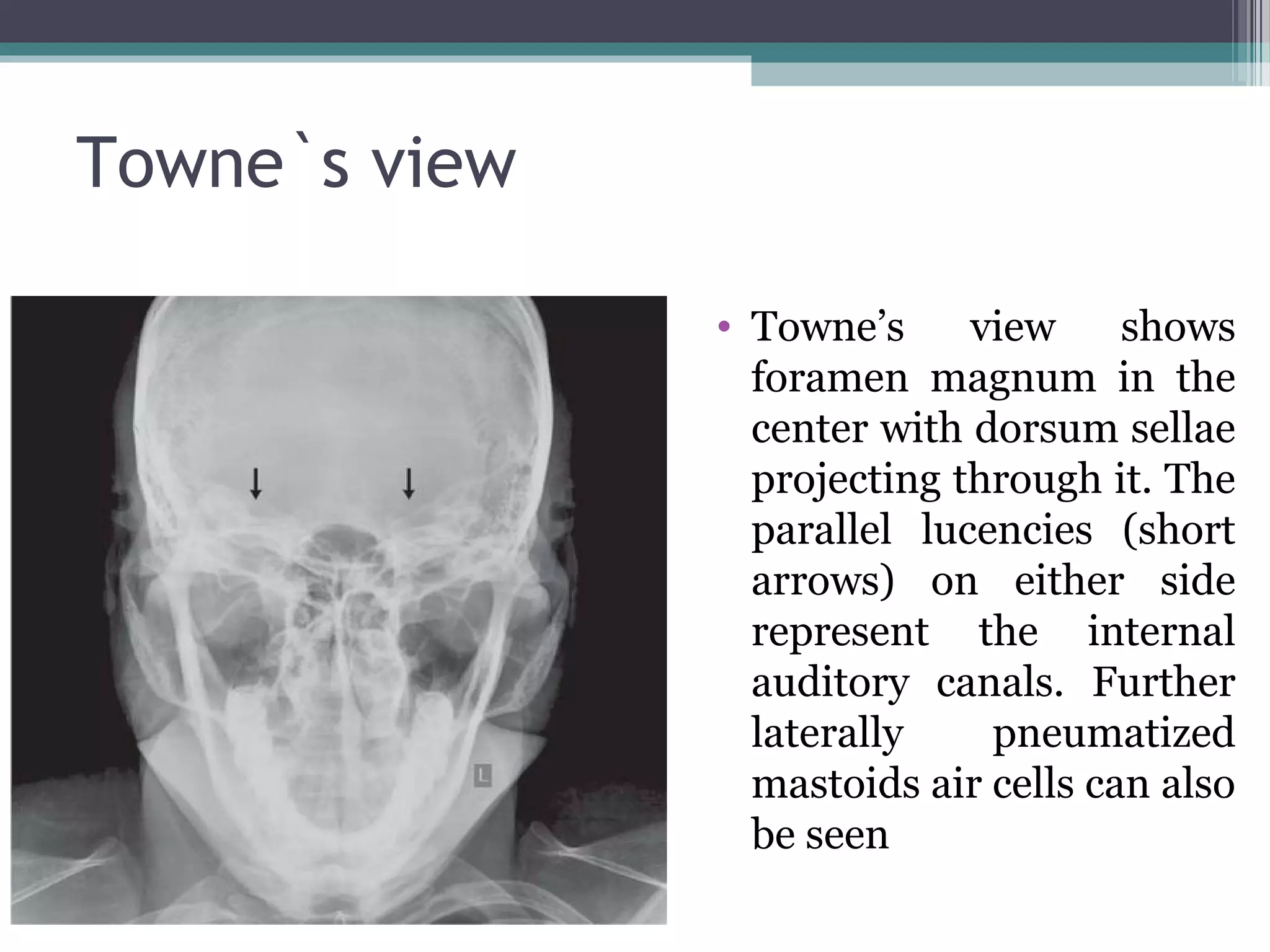 Towne`s view
• Towne’s view shows
foramen magnum in the
center with dorsum sellae
projecting through it. The
parallel lucencies (short
arrows) on either side
represent the internal
auditory canals. Further
laterally pneumatized
mastoids air cells can also
be seen
 