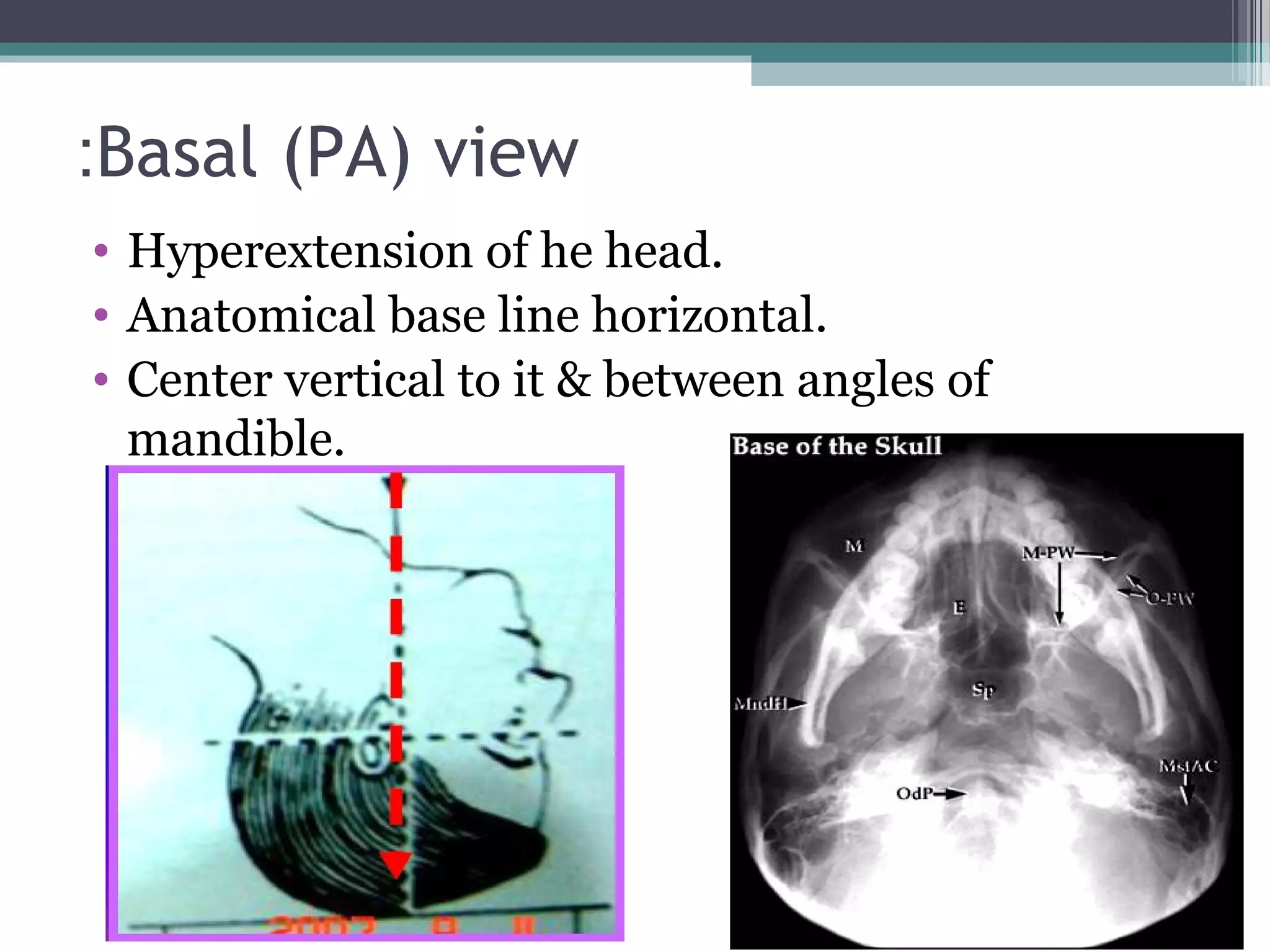 Basal (PA) view:
• Hyperextension of he head.
• Anatomical base line horizontal.
• Center vertical to it & between angles of
mandible.
 