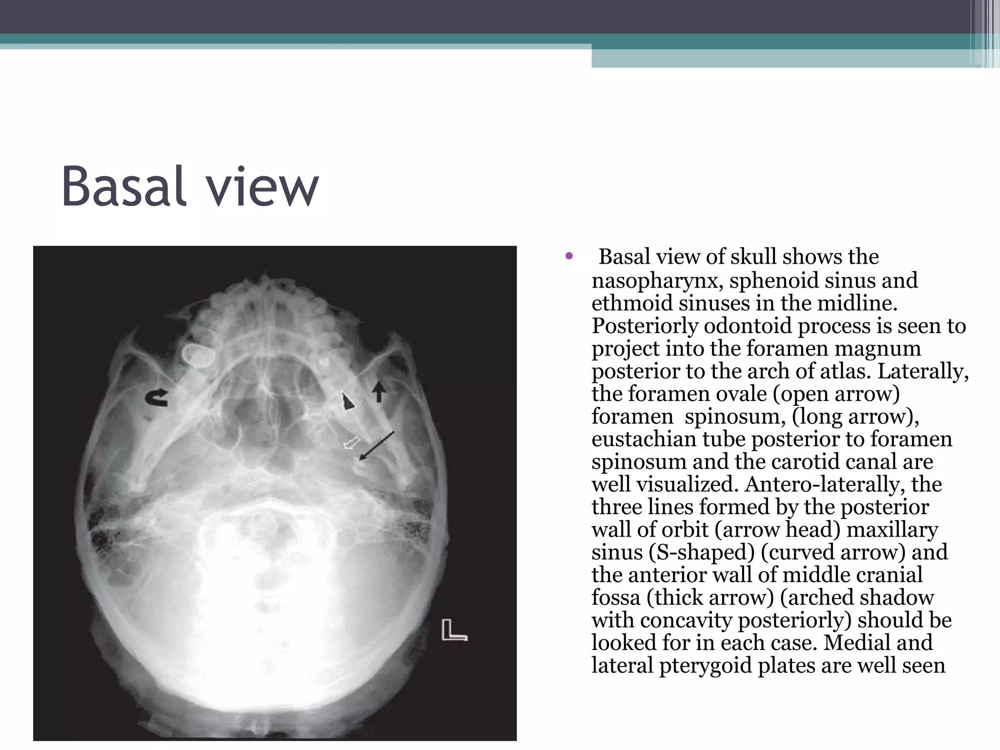 Basal view
• Basal view of skull shows the
nasopharynx, sphenoid sinus and
ethmoid sinuses in the midline.
Posteriorly odontoid process is seen to
project into the foramen magnum
posterior to the arch of atlas. Laterally,
the foramen ovale (open arrow)
foramen spinosum, (long arrow),
eustachian tube posterior to foramen
spinosum and the carotid canal are
well visualized. Antero-laterally, the
three lines formed by the posterior
wall of orbit (arrow head) maxillary
sinus (S-shaped) (curved arrow) and
the anterior wall of middle cranial
fossa (thick arrow) (arched shadow
with concavity posteriorly) should be
looked for in each case. Medial and
lateral pterygoid plates are well seen
 