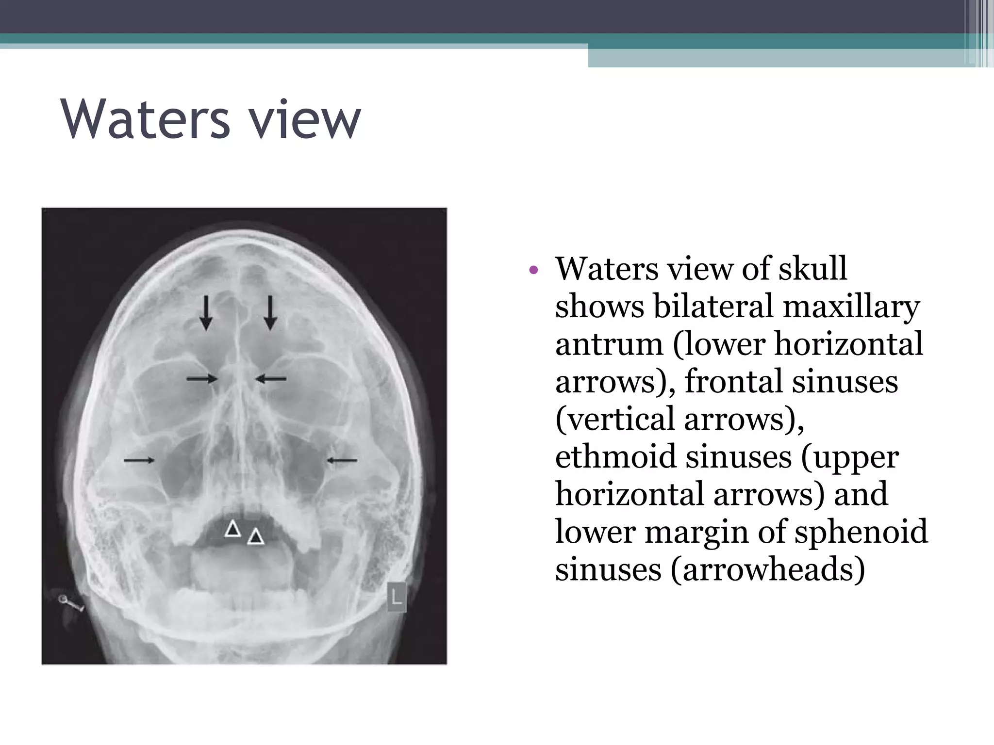 Waters view
• Waters view of skull
shows bilateral maxillary
antrum (lower horizontal
arrows), frontal sinuses
(vertical arrows),
ethmoid sinuses (upper
horizontal arrows) and
lower margin of sphenoid
sinuses (arrowheads)
 