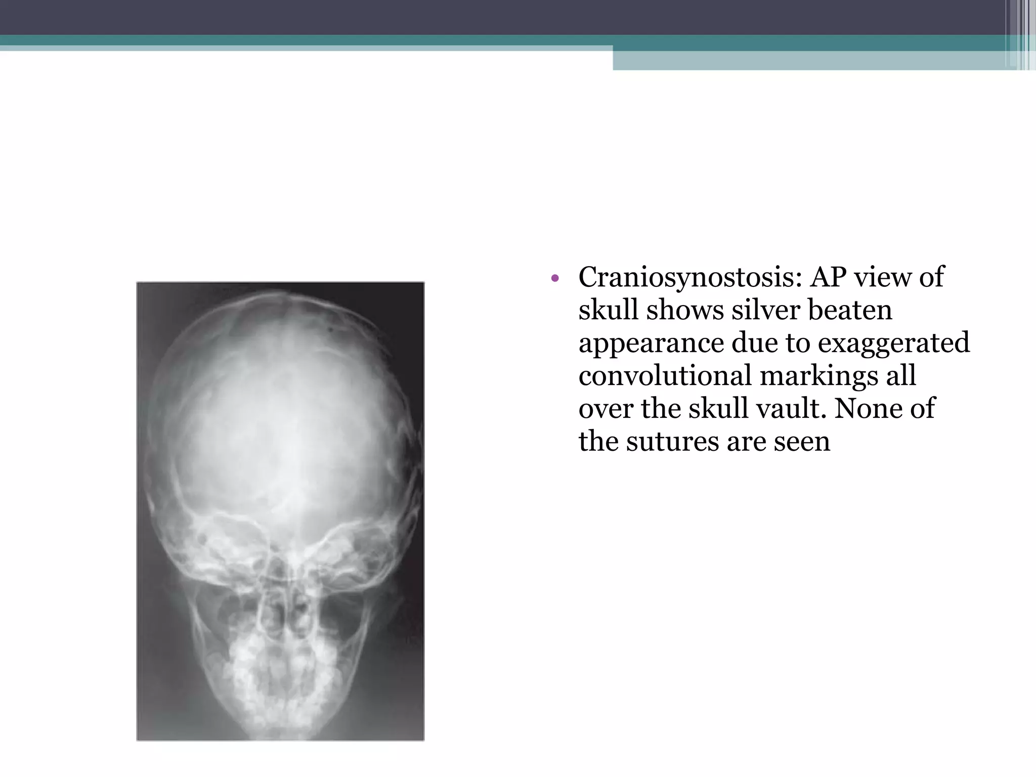 • Craniosynostosis: AP view of
skull shows silver beaten
appearance due to exaggerated
convolutional markings all
over the skull vault. None of
the sutures are seen
 