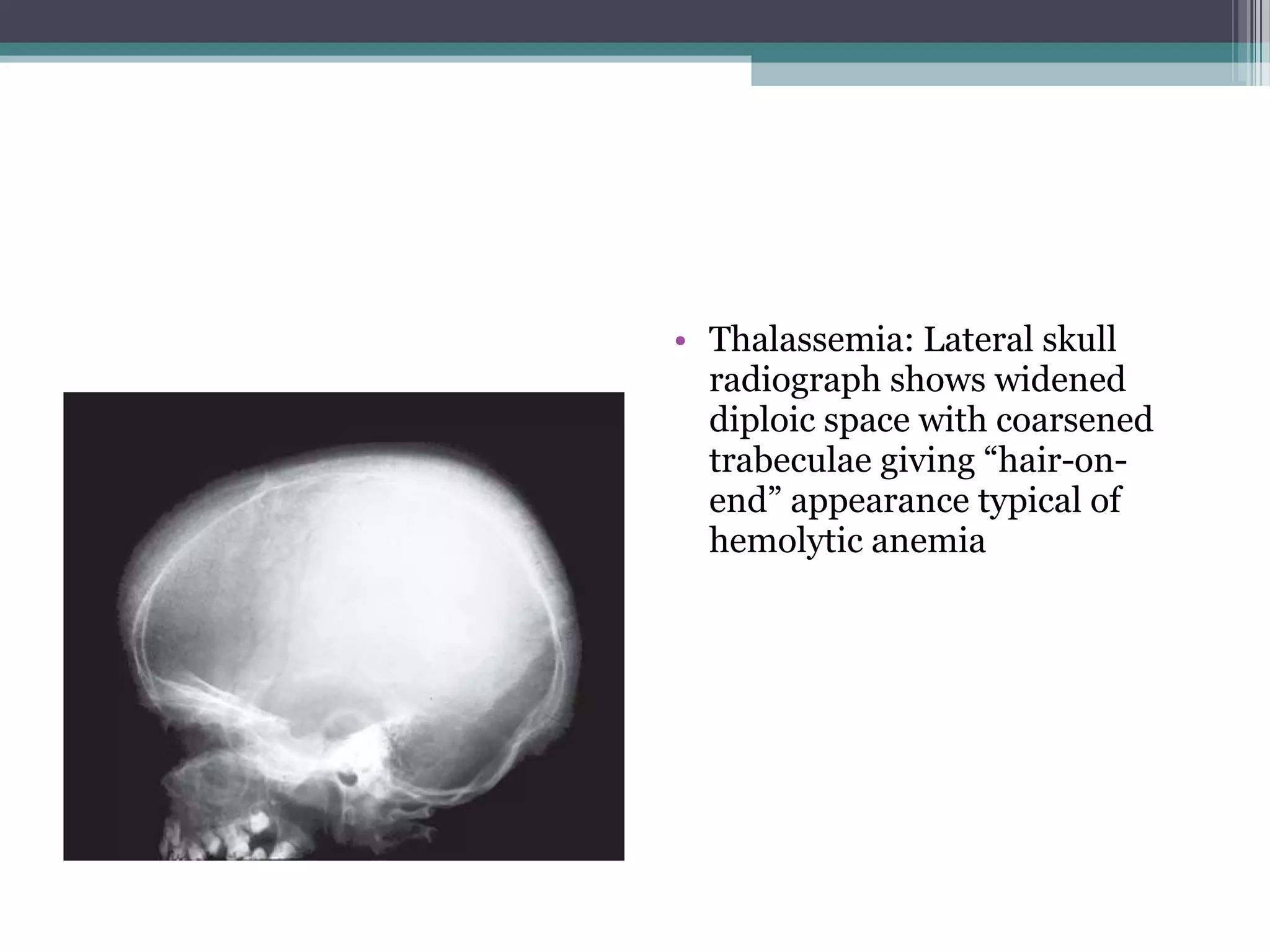 • Thalassemia: Lateral skull
radiograph shows widened
diploic space with coarsened
trabeculae giving “hair-on-
end” appearance typical of
hemolytic anemia
 