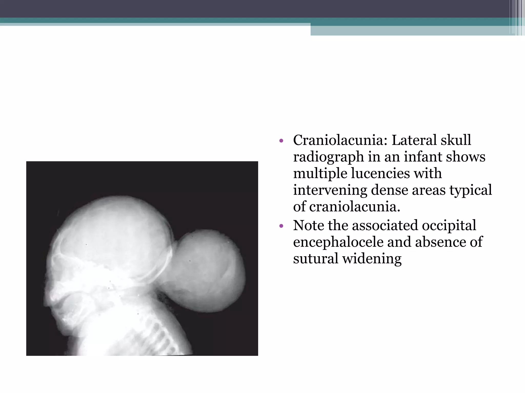 • Craniolacunia: Lateral skull
radiograph in an infant shows
multiple lucencies with
intervening dense areas typical
of craniolacunia.
• Note the associated occipital
encephalocele and absence of
sutural widening
 