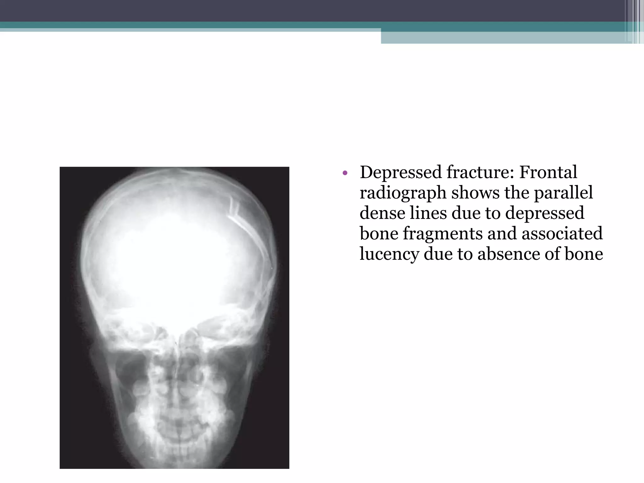 • Depressed fracture: Frontal
radiograph shows the parallel
dense lines due to depressed
bone fragments and associated
lucency due to absence of bone
 