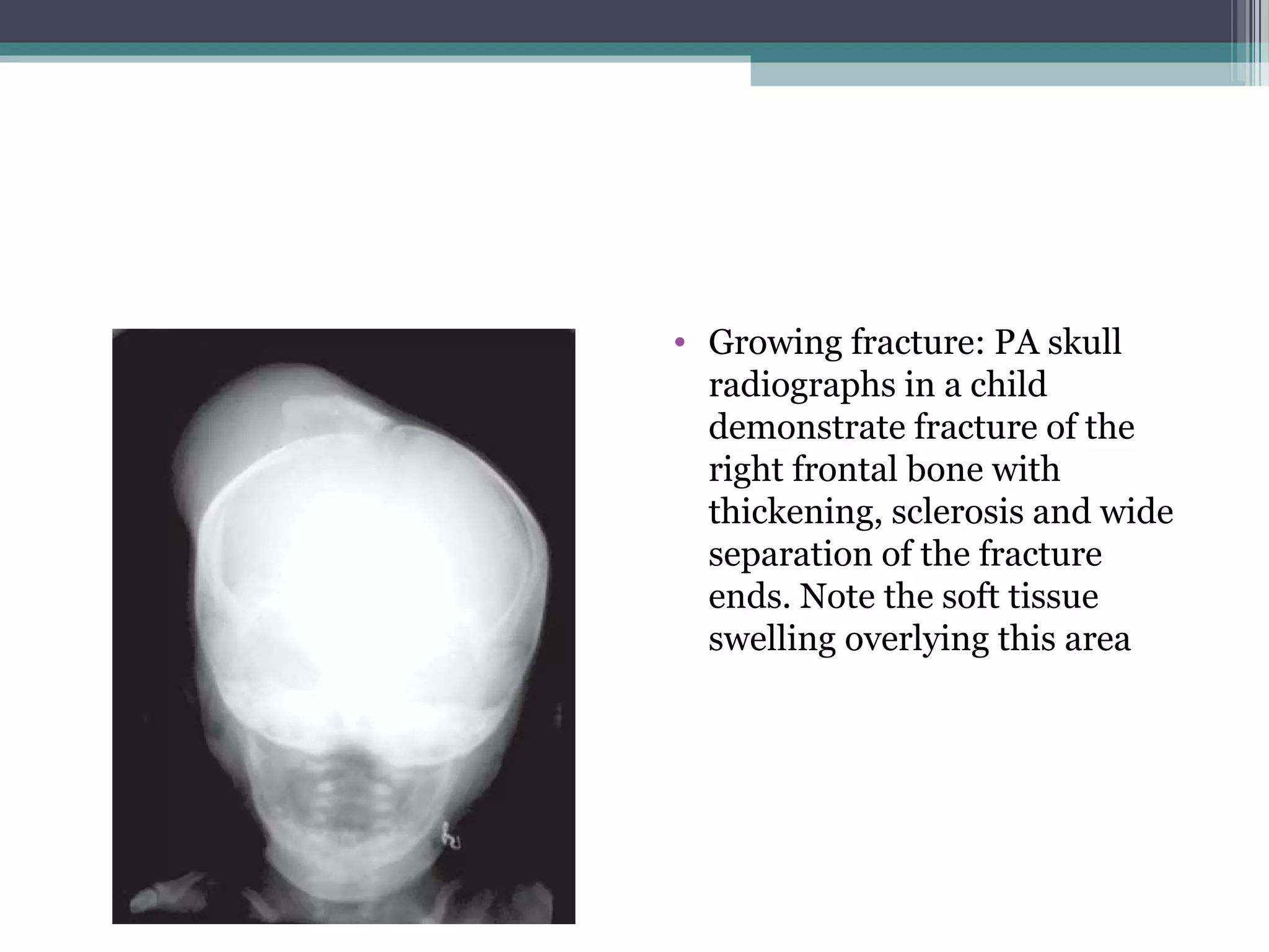 • Growing fracture: PA skull
radiographs in a child
demonstrate fracture of the
right frontal bone with
thickening, sclerosis and wide
separation of the fracture
ends. Note the soft tissue
swelling overlying this area
 