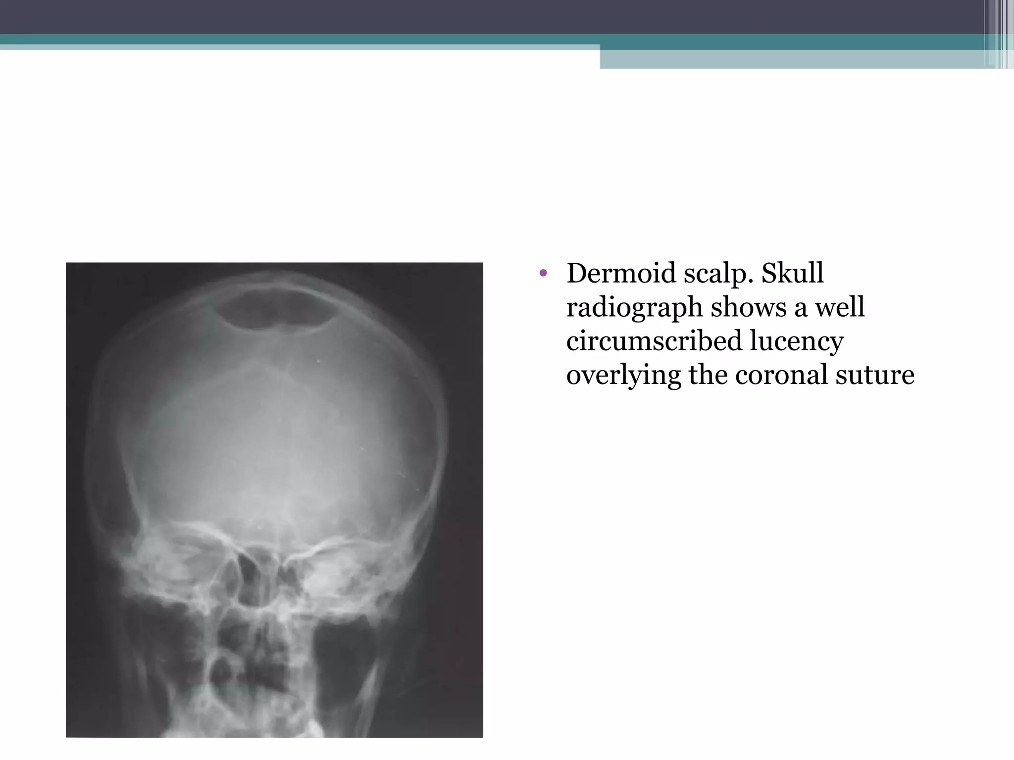 • Dermoid scalp. Skull
radiograph shows a well
circumscribed lucency
overlying the coronal suture
 