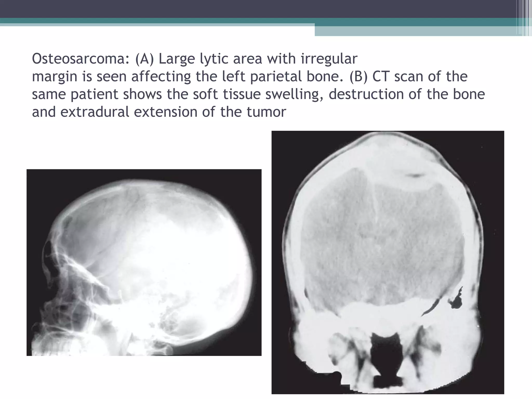 Osteosarcoma: (A) Large lytic area with irregular
margin is seen affecting the left parietal bone. (B) CT scan of the
same patient shows the soft tissue swelling, destruction of the bone
and extradural extension of the tumor
 