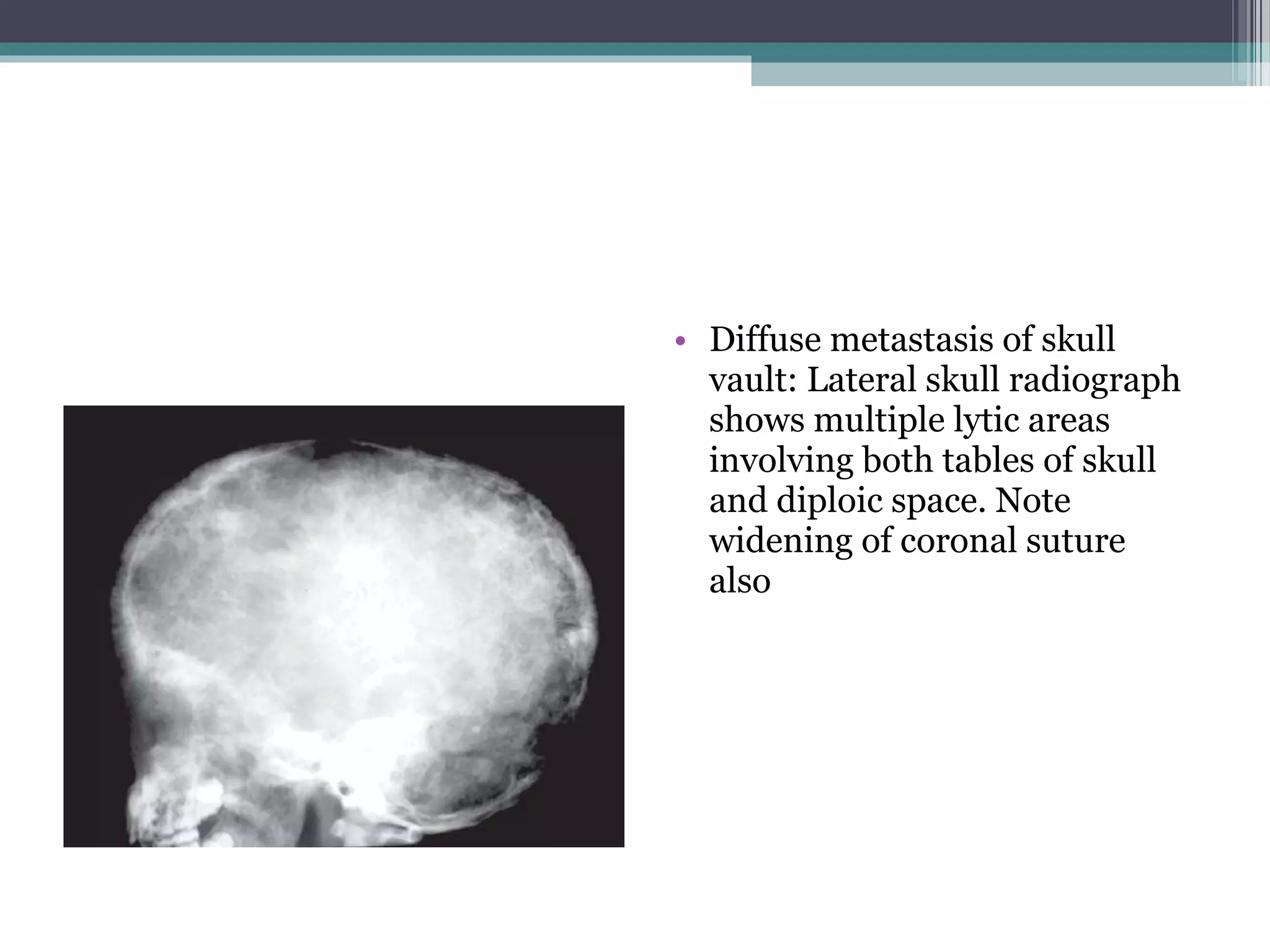 • Diffuse metastasis of skull
vault: Lateral skull radiograph
shows multiple lytic areas
involving both tables of skull
and diploic space. Note
widening of coronal suture
also
 